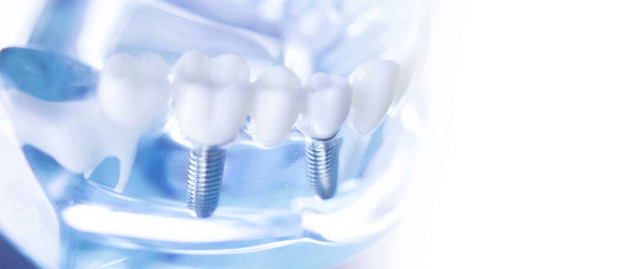 יישור שיניים מהיר למבוגרים ברחובות – הדרך לחיוך מסודר ובטוח